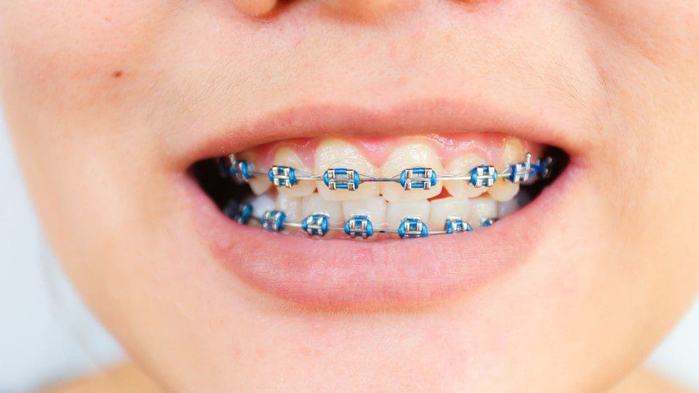 Comprehensive Guide to Braces in Ipswich and Brassall